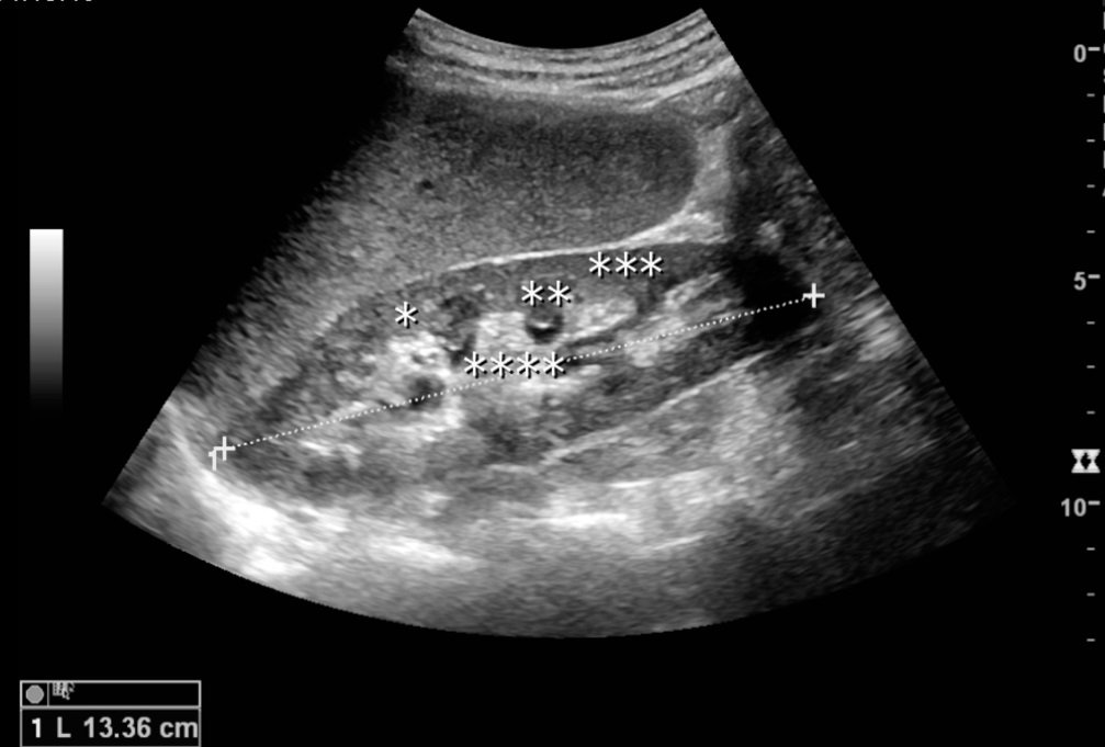 Imagen de referencia de ecografía renal en modo B